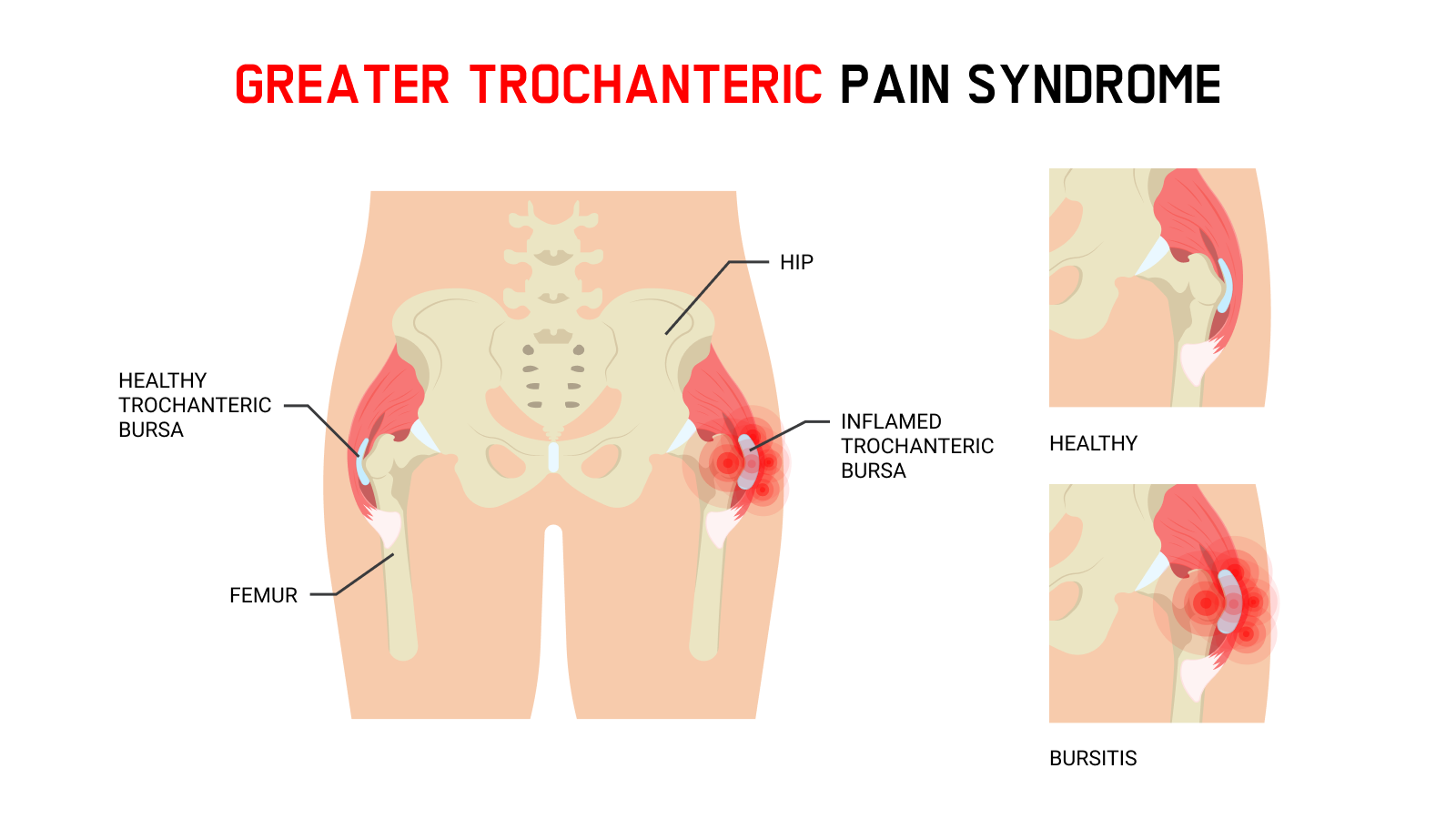 Greater trochanteric pain syndrome